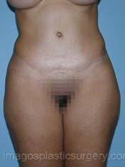 after front view tummy tuck of female patient 2718