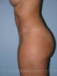 after left side view tummy tuck of female patient 2718