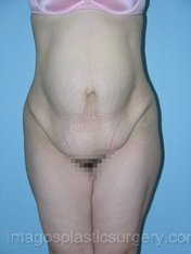 before front view tummy tuck of female patient 2723