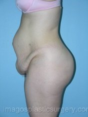 before left side view tummy tuck of female patient 2723