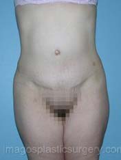 after front view tummy tuck of female patient 2723
