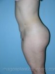 after left side view tummy tuck of female patient 2723