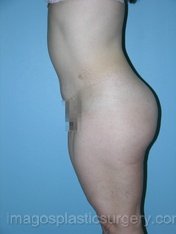 after left side view tummy tuck of female patient 2723