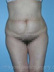 before front view tummy tuck of female patient 2728