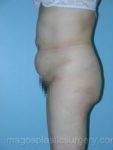 before left side view tummy tuck of female patient 2728