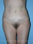 after front view tummy tuck of female patient 2728