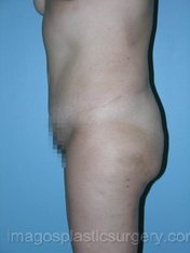 after left side view tummy tuck of female patient 2728