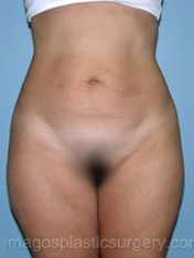 before front view tummy tuck of female patient 2733