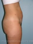 before right side view tummy tuck of female patient 2733