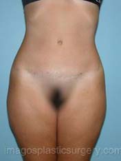 after front view tummy tuck of female patient 2733