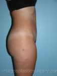 after left side view tummy tuck of female patient 2733