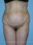 before front view tummy tuck of female patient 2747