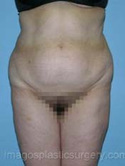 before front view tummy tuck of female patient 2747