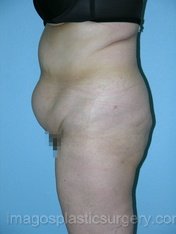 before left side view tummy tuck of female patient 2747