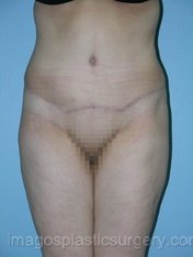 after front view tummy tuck of female patient 2747