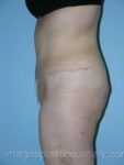 after left side view tummy tuck of female patient 2747
