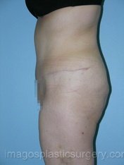 after left side view tummy tuck of female patient 2747