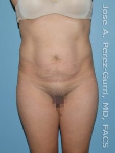 before front view tummy tuck of female patient 2754