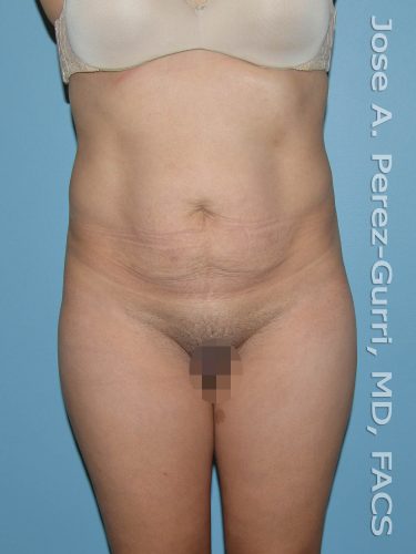 before front view tummy tuck of female patient 2754