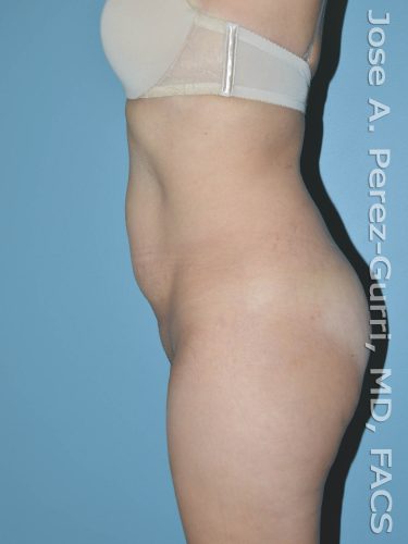 before left side view tummy tuck of female patient 2754