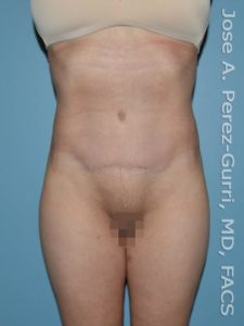 after front view tummy tuck of female patient 2754