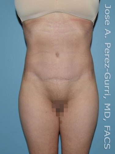 after front view tummy tuck of female patient 2754