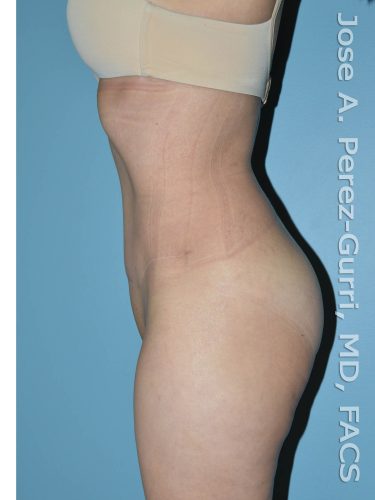 after left side view tummy tuck of female patient 2754