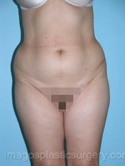 before front view tummy tuck of female patient 2763