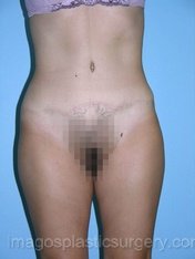 after front view tummy tuck of female patient 2763