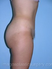 after right side view tummy tuck of female patient 2763