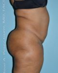 before right side view tummy tuck of female patient 2768