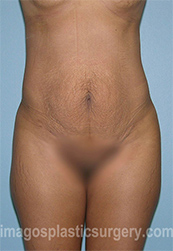 before front view tummy tuck of female patient 2778