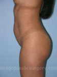 before left side view tummy tuck of female patient 2778