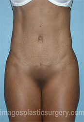 after front view tummy tuck of female patient 2778