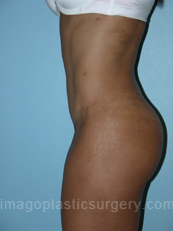 after left side view tummy tuck of female patient 2778