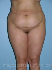 before front view tummy tuck of female patient 2784