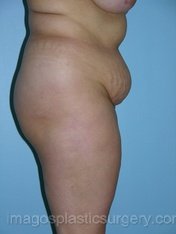 before right side view tummy tuck of female patient 2784