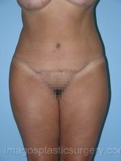 after front view tummy tuck of female patient 2784