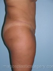 after right side view tummy tuck of female patient 2784