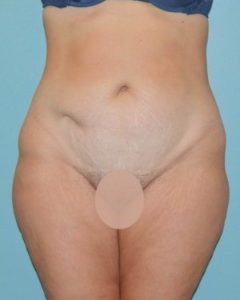 before front view tummy tuck of female patient 2799