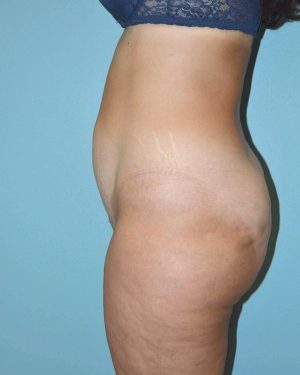 before left side view tummy tuck of female patient 2799
