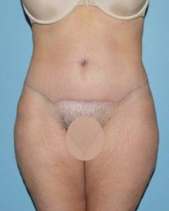 after front view tummy tuck of female patient 2799