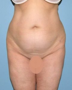 before front view tummy tuck of female patient 2804