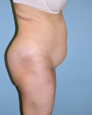 before right side view tummy tuck of female patient 2804
