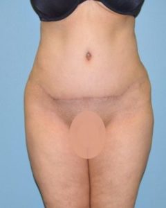 after front view tummy tuck of female patient 2804