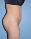 after right side view tummy tuck of female patient 2804