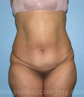 before front view tummy tuck of female patient 2809
