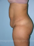before left side view tummy tuck of female patient 2809