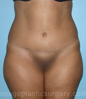 after front view tummy tuck of female patient 2809