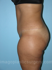 after left side view tummy tuck of female patient 2809